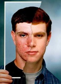 El tabaquismo provoca acné