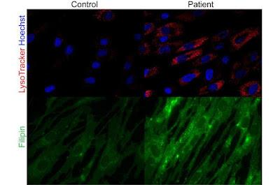 Resuelven misterio médico de esta enfermedad multiorgánica