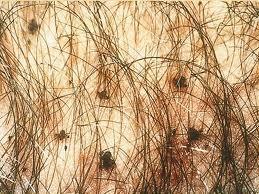  ¿Qué es el Pthirus Pubis?