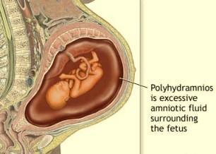 ¿Qué son los polihidramnios?