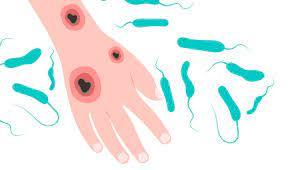 ¿Cuáles son los síntomas de la bacteria come carne?