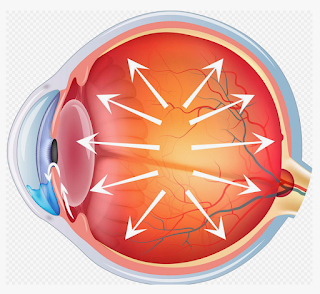 Cómo los nuevos lentes de contacto están transformando el cuidado del glaucoma.