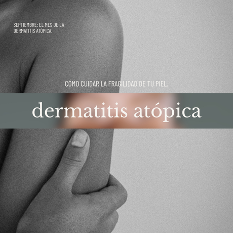 descubrí todo sobre la dermatitis atópica. causas, síntomas, tratamientos médicos, recomendación de una dermatóloga y tips y productos recomendados.