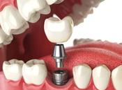 Cómo coloca implante dental Málaga; Paso paso dolor