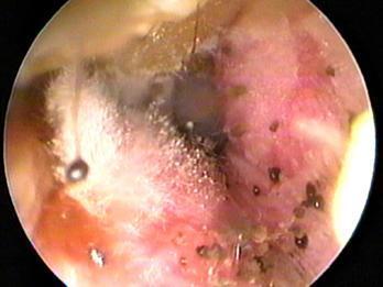 Otomicosis.