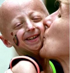 Progeria 240x250 Día raro, enfermedades raras