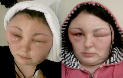 INCREÍBLE: La cara de una mujer tras reaccionar alérgicamente a un tinte... de cabello