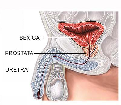 Câncer de Próstata La combinación de terapias parece funcionar bien para tratar el cáncer prostático de alto riesgo