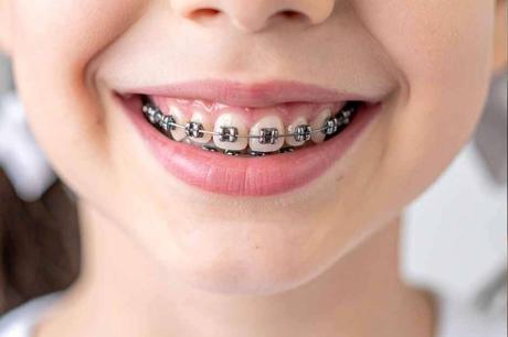 Ortodoncia infantil; guía para una sonrisa saludable desde pequeños