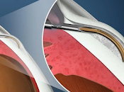 Investigadores desarrollan microstent cabe dentro aguja hipodérmica.