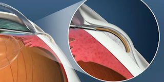 Investigadores desarrollan un microstent que cabe dentro de una aguja hipodérmica.