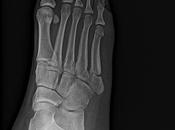 Fractura metáfisis proximal quinto metatarsiano, datos pseudoartrosis,