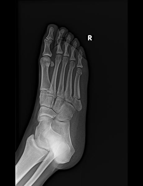 Fractura de la metáfisis proximal del quinto metatarsiano, con datos de pseudoartrosis,