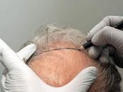 Jesús Aníbal Mora, especialista trasplante capilar enfoque personalizado resultados naturales