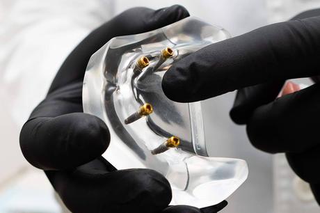 Implantes dentales de alta precisión y estética en Clínica Calvo de Mora, referencia en Madrid