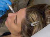 Vampiro facial, tratamiento médico-estético estimula regeneración natural piel