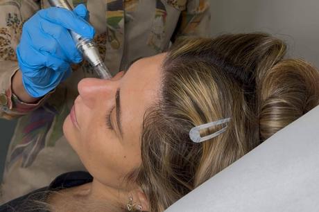 Vampiro facial, el tratamiento médico-estético que estimula la regeneración natural de la piel