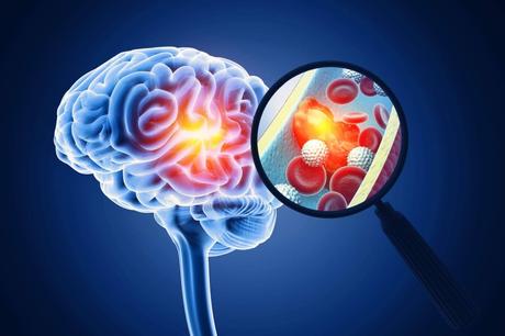 Reconocer un ictus en sus primeras fases permite reducir secuelas y mejorar la recuperación