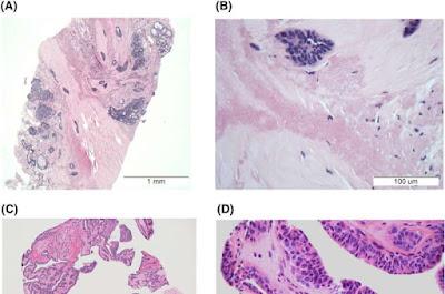 La cirugía puede no ser necesaria en algunas lesiones mamarias