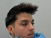 Ácido hialurónico tratamiento antiarrugas; combinación efectiva medicina estética para rejuvenecimiento completo