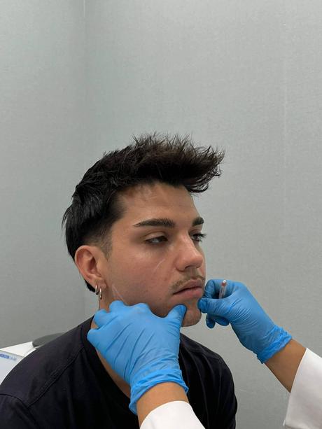 Ácido hialurónico y tratamiento antiarrugas; la combinación más efectiva en medicina estética para un rejuvenecimiento completo