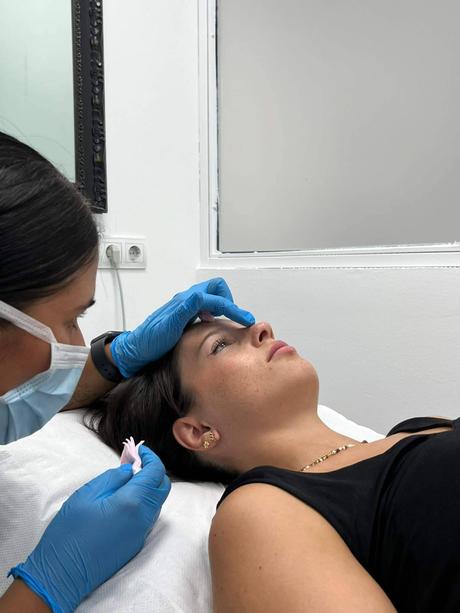 El código de barras; qué es, por qué aparece y cómo eliminarlo con medicina estética