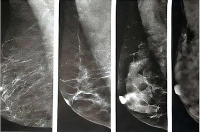 Las Mamas densas dificultan el diagnostico de Cáncer