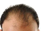 HairFluencer incorpora Evocapil como línea experta tratamiento integral caída cabello