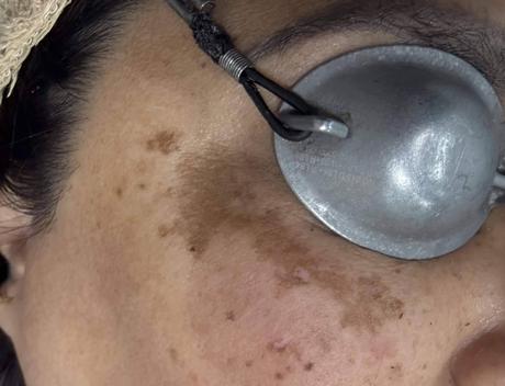 La Dra. Janeth Arévalo analiza los factores que agravan el melasma y los alimentos que influyen en su evolución La Dra. Janeth Arévalo analiza los factores que agravan el melasma y los alimentos que influyen en su evolución