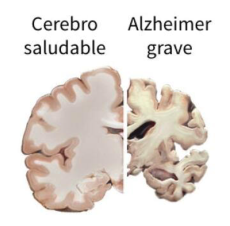 Alzheimer: el síntoma temprano que se puede detectar en la ducha, según neurólogos Alzheimer: el síntoma temprano que se puede detectar en la ducha, según neurólogos