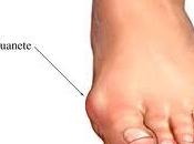 Remedio para molestos juanetes