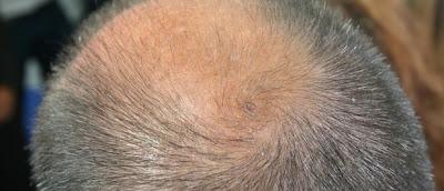 Asocia la calvicie y los problemas de próstata