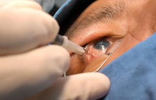 Glaucoma, enfermedad irreversible que afecta a personas mayores de 40 años