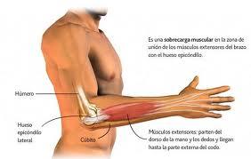 EPICONDILITIS:  Codo de tenista y de golfista