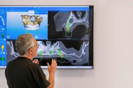 Las clínicas Exö Höllenback aplican una técnica avanzada para pacientes con atrofia ósea severa Las clínicas Exö Höllenback aplican una técnica avanzada para pacientes con atrofia ósea severa