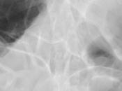 severa dilatación asas intestinales