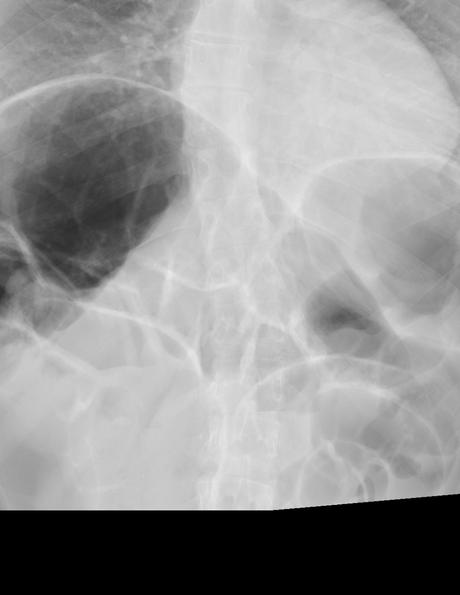 severa dilatación de las asas intestinales