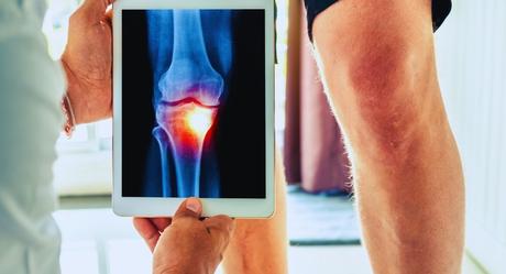 Caminar, pedalear o nadar, el mejor ejercicio para la artrosis de rodilla, según un estudio _mejor ejercicio para la artrosis de rodilla