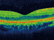Glaucoma nuevas tecnologías.