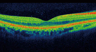 Glaucoma y nuevas tecnologías.