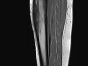 Cambios densidad ósea tibia