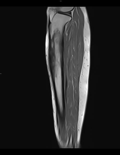 Cambios en la densidad ósea de la tibia