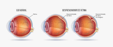 Ver destellos y puntos flotando puede indicar una separación de vítreo o desprendimiento de retina.