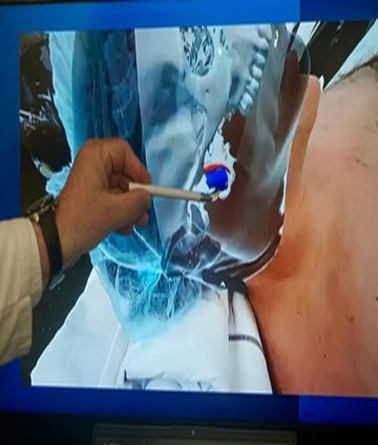 La cirugía del futuro ya se hace en un hospital público de Coghlan: como se opera con realidad aumentada