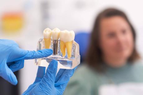 Los implantes dentales se consolidan como la opción preferida para recuperar dientes perdidos Los implantes dentales se consolidan como la opción preferida para recuperar dientes perdidos