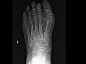 Existe aparente fractura proceso posterior astrágalo. cuneiforme asociación nivel bases metatarsiano, edema asociado