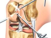 Artroscopia