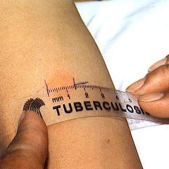 España continúa con un elevado número de pacientes con tuberculosis, según la SEPAR