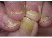 Psoriasis