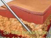 ¿qué liposucción?
